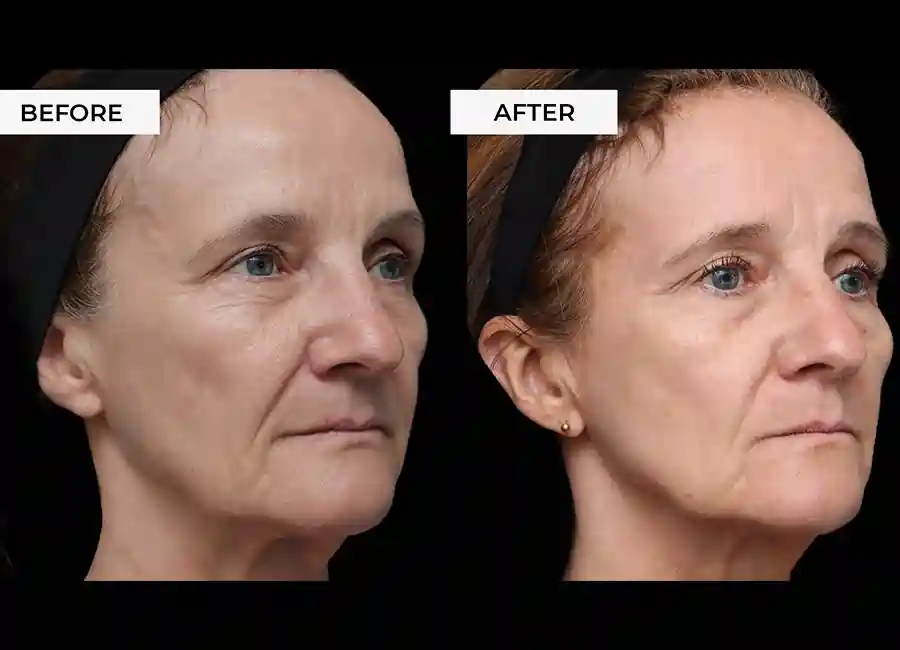 How Many RF Microneedling Sessions Will You Need to See a Difference Chippenham?