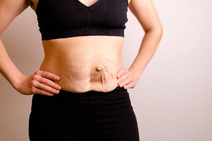 Is Surgery Really the Only Way to Repair Diastasis Recti Chippenham?