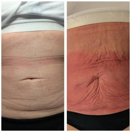 How Does RF Microneedling Improve Crepey, Thin and Uneven Skin Texture Chippenham?