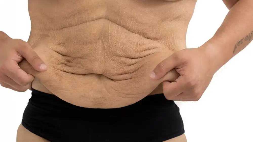 Why Does Weight Loss Medication Leave Some People With Loose or Sagging Skin Chippenham?